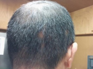 円形脱毛症